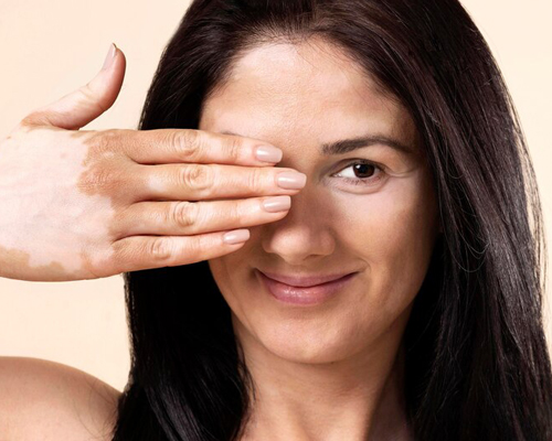 Pigmentation Treatment